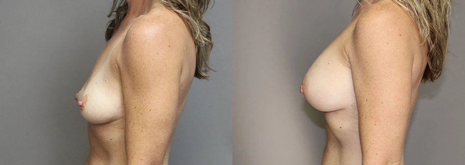 5861-breastaug-p01-3