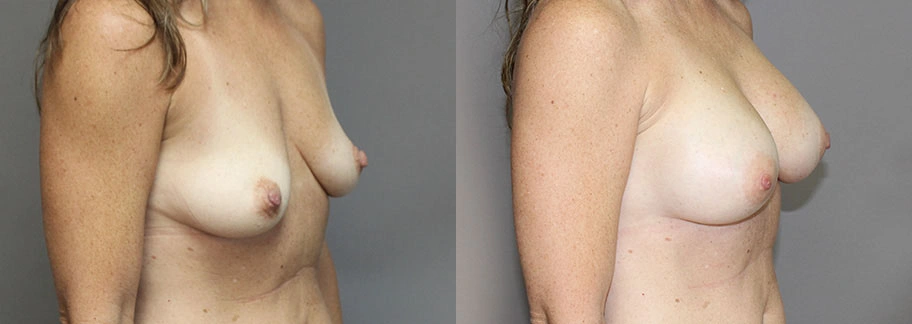 5862-breastaug-p01-4