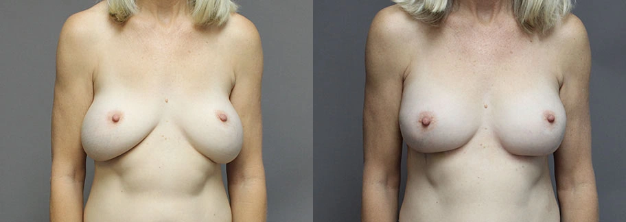 5863-breastaug-p02-1