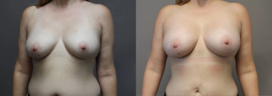 5866-breastaug-p03-1