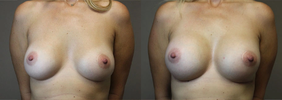 5868-breastaug-p04-1