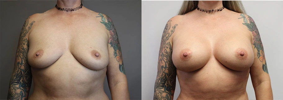 5894-breastaug-p05-1