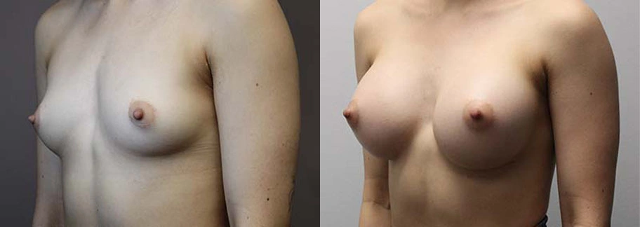 5895-breastaug-p06-1