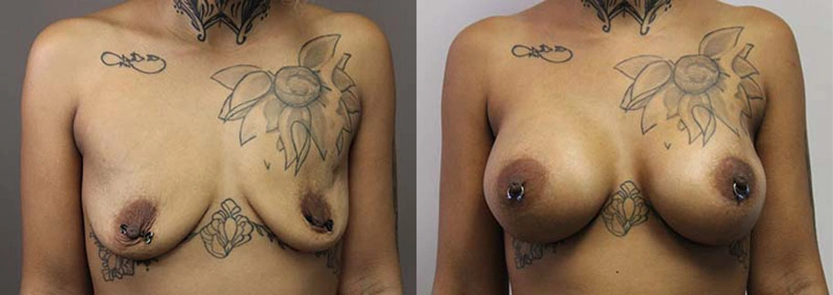 5898-breastaug-p07-1