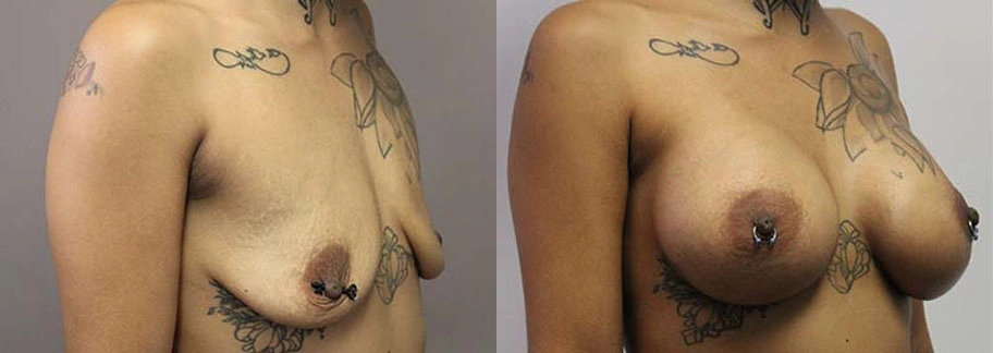 5900-breastaug-p07-2