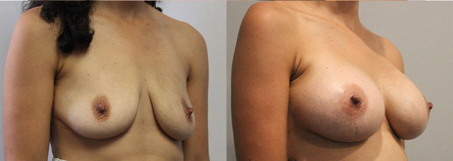 5903-breastaug-p09-1