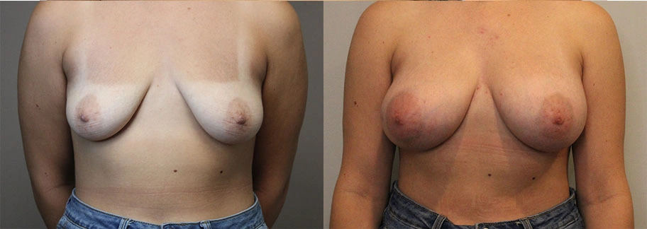 5825-breastaug-p10-1