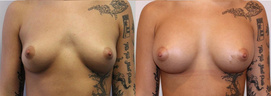 5826-breastaug-p11-1