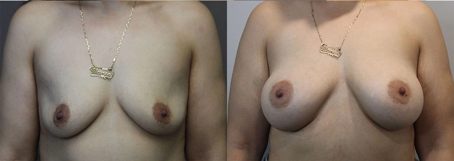 5832-breastaug-p13-1