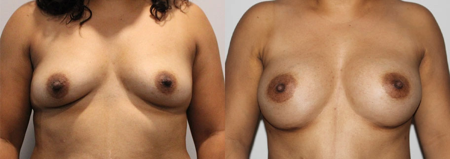 5843-breastaug-p17-1