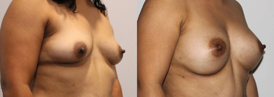 5845-breastaug-p17-2