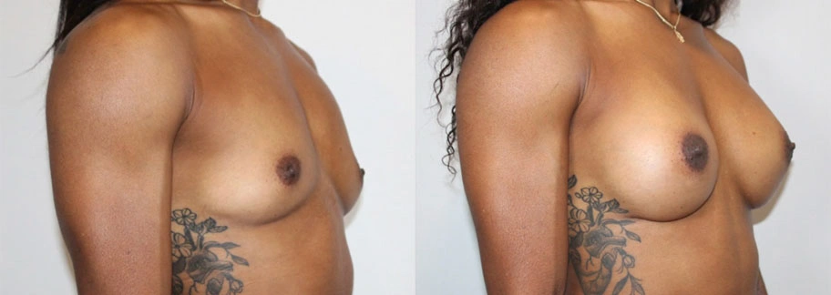 5850-breastaug-p20-1