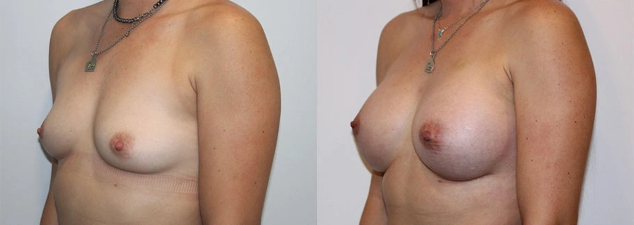 5852-breastaug-p21-1