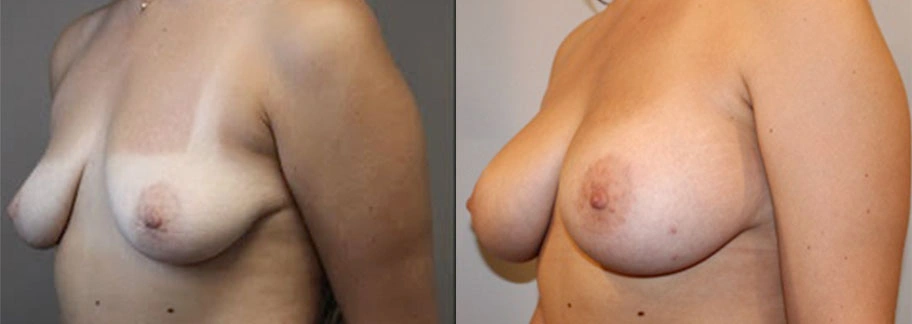 5856-breastaug-p23-1