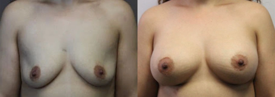 5872-breastaug-p25-1