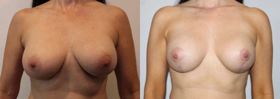 5874-breastaug-p26-1