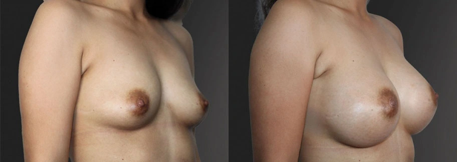 5878-breastaug-p28-1