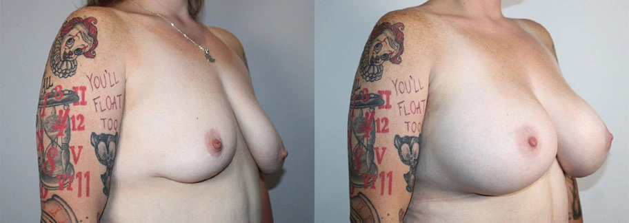 5880-breastaug-p29-1