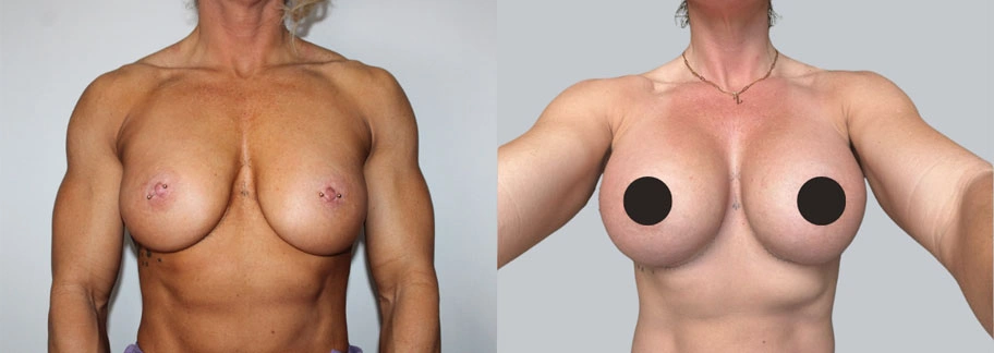 5882-breastaug-p30-1