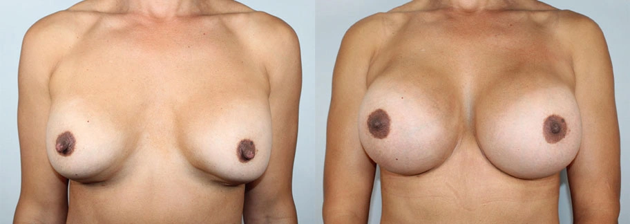 5891-breastaug-p34-1