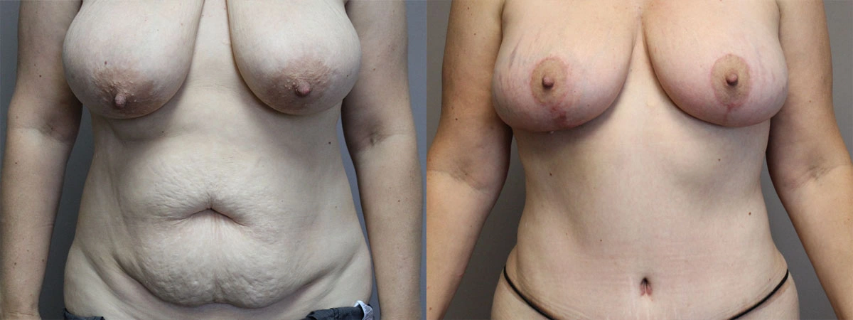 5906-breastlift-p01-1
