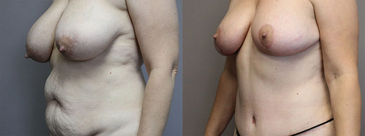 5907-breastlift-p01-2