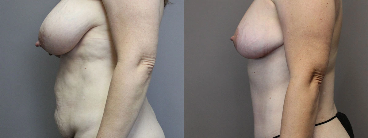 5908-breastlift-p01-3