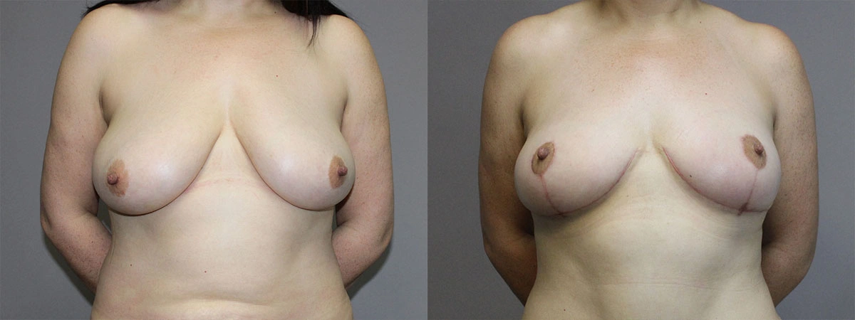 5909-breastlift-p02-1