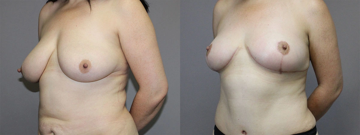 5911-breastlift-p02-2