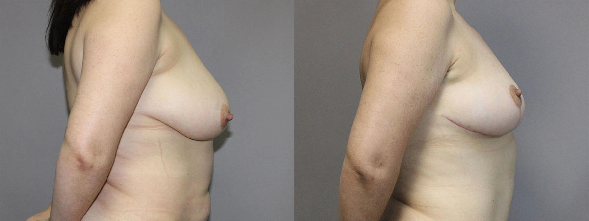 5912-breastlift-p02-3