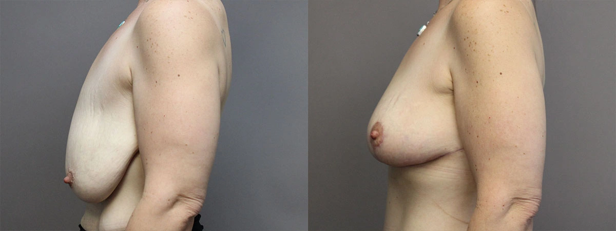 5913-breastlift-p03-1