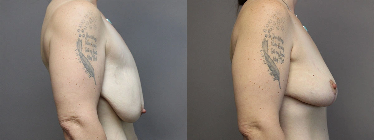 5915-breastlift-p03-2