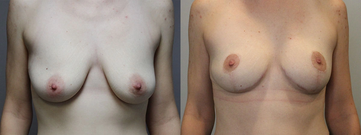 5916-breastlift-p04-1
