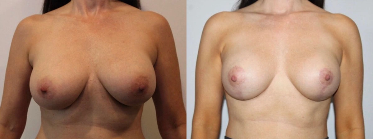 5918-breastlift-p05-1