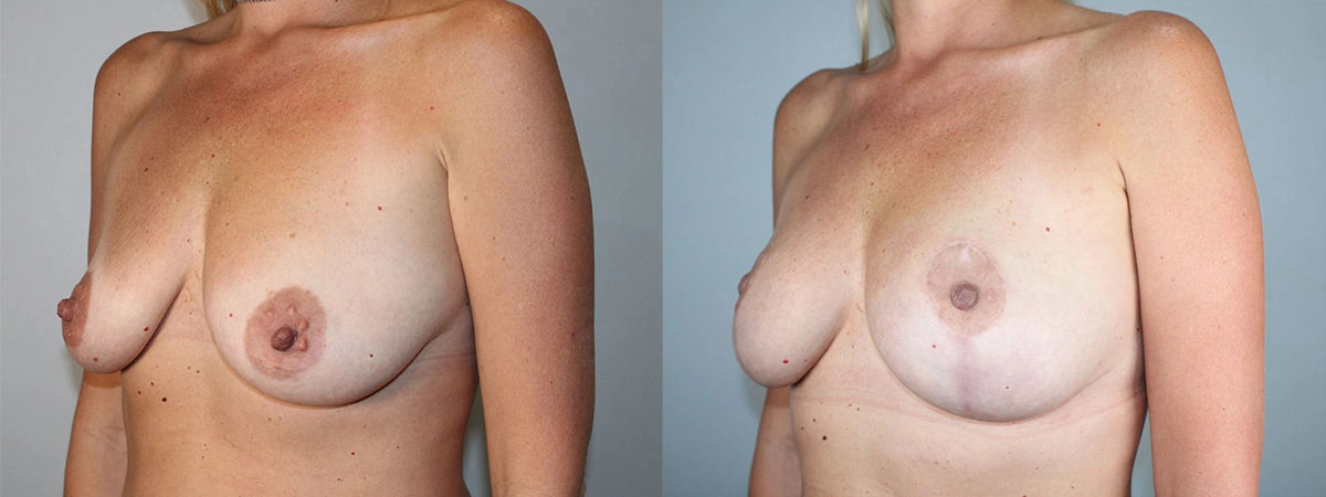 5920-breastlift-p06-1