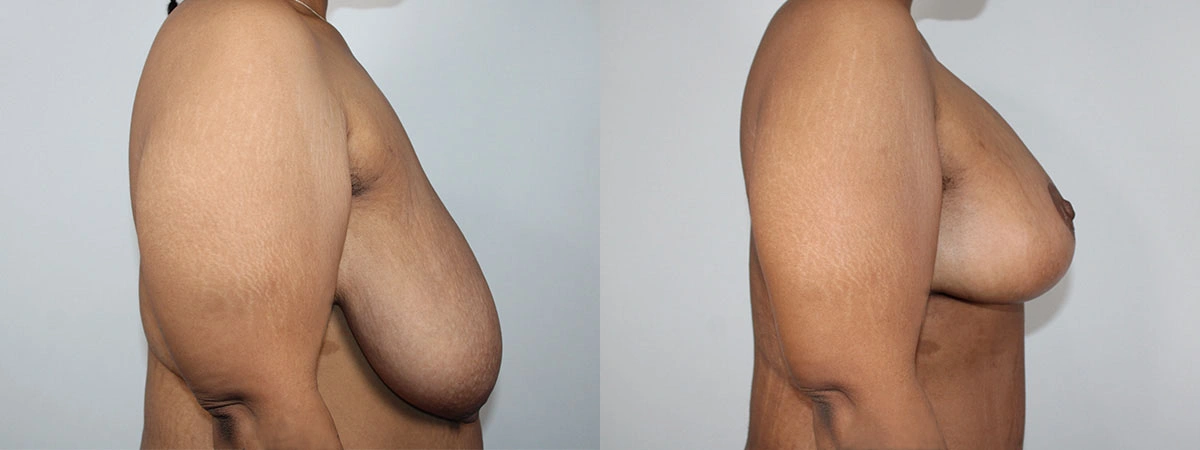 5922-breastlift-p07-1