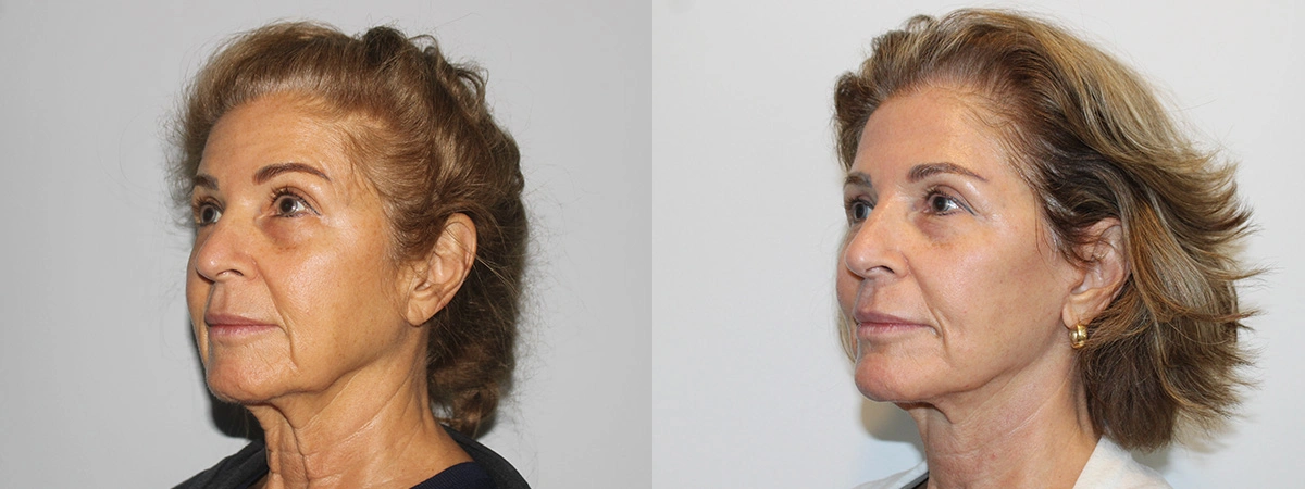 6215-facerejuv-p09-1