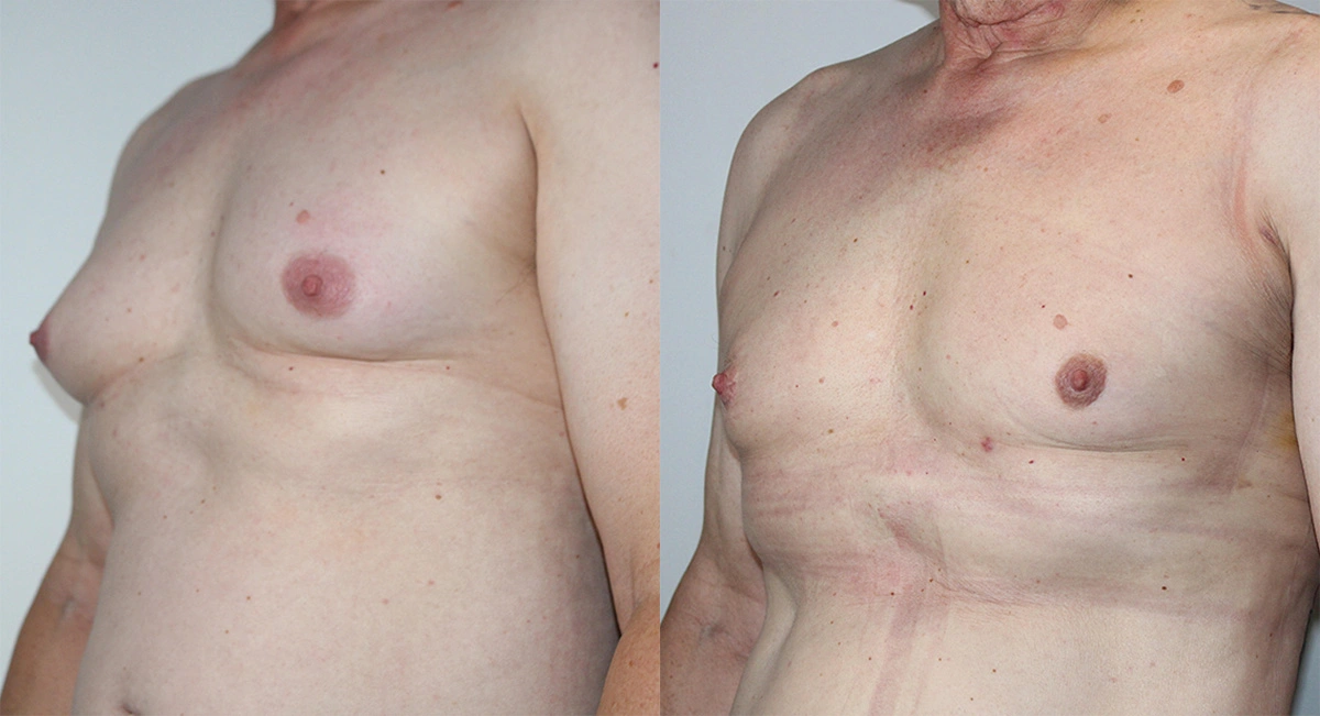 Before and After Plastic Surgery Results | CraftMD Scottsdale & Phoenix, AZ
