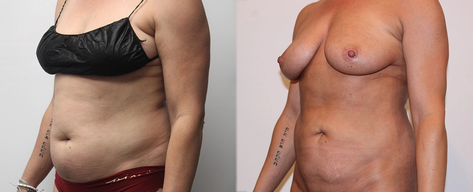 6030-lipo-p05-2