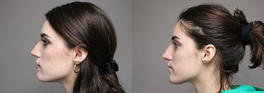 Before and After Plastic Surgery Results | CraftMD Scottsdale & Phoenix, AZ