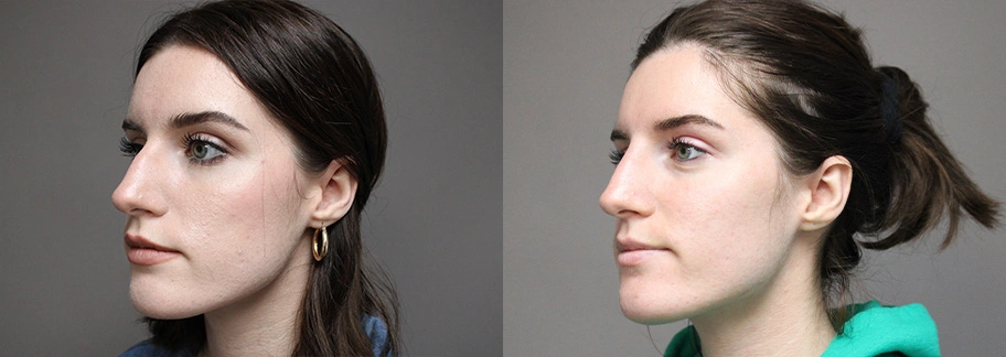 Before and After Plastic Surgery Results | CraftMD Scottsdale & Phoenix, AZ