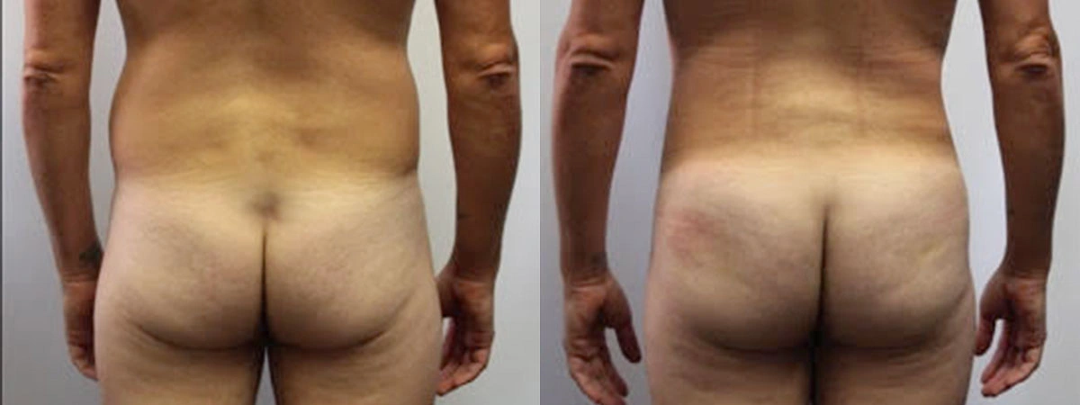 Before and After Plastic Surgery Results | CraftMD Scottsdale & Phoenix, AZ