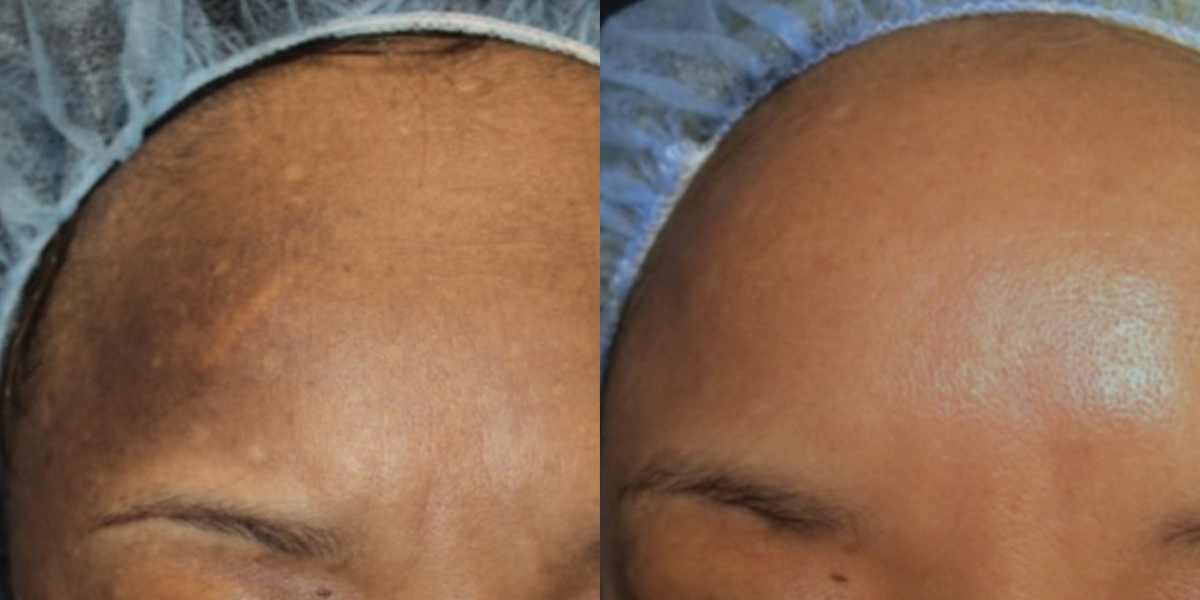 melasma p01-1