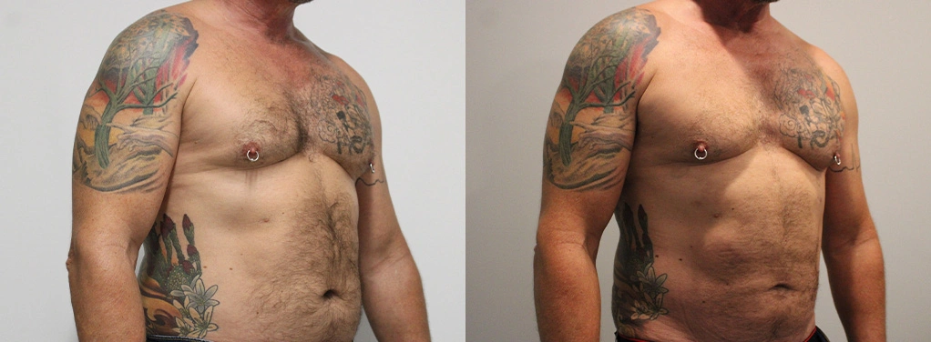 Before and After Plastic Surgery Results | CraftMD Scottsdale & Phoenix, AZ