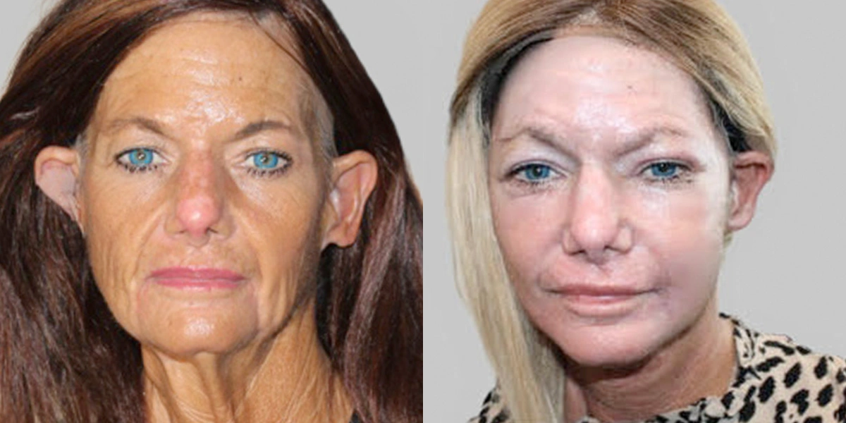 Before and After Plastic Surgery Results | CraftMD Scottsdale & Phoenix, AZ
