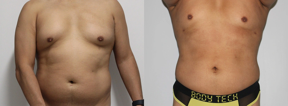 Before and After Plastic Surgery Results | CraftMD Scottsdale & Phoenix, AZ