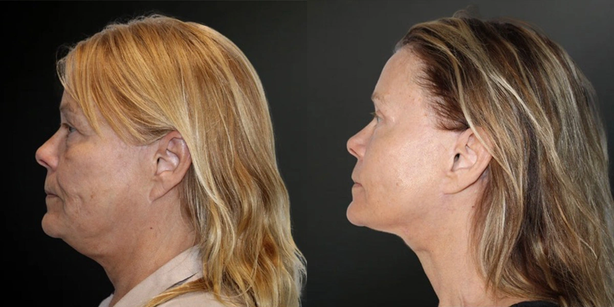 Before and After Plastic Surgery Results | CraftMD Scottsdale & Phoenix, AZ