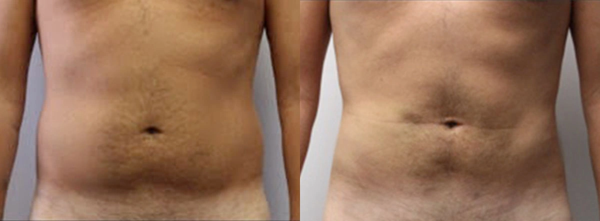 Before and After Plastic Surgery Results | CraftMD Scottsdale & Phoenix, AZ