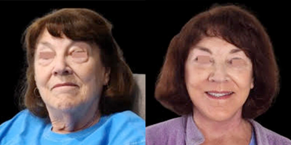 Before and After Plastic Surgery Results | CraftMD Scottsdale & Phoenix, AZ