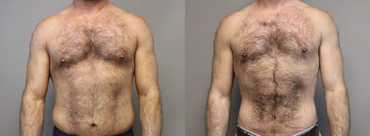 Before and After Plastic Surgery Results | CraftMD Scottsdale & Phoenix, AZ